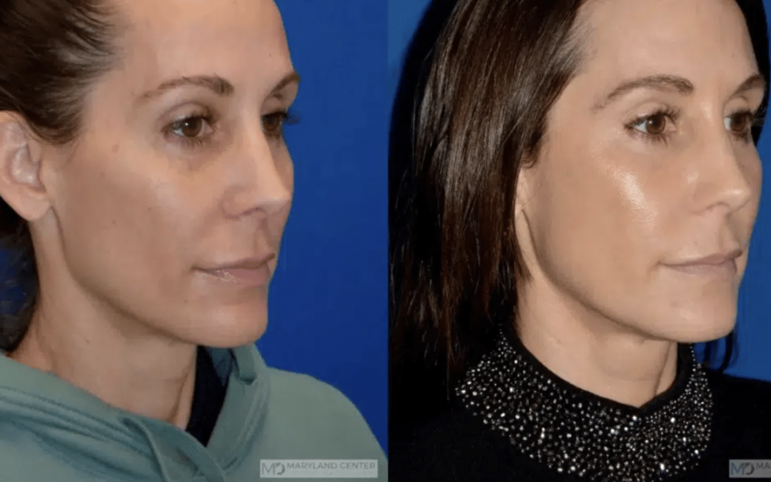 Surgical vs Non-Surgical Facelift: Is Surgery Really Necessary? 